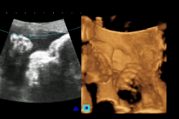 Imagem: Imagem de ultrassonografia de um bebê realizada com aparelho 4D